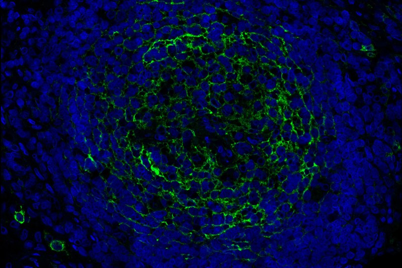 HumaHuman metastatic melanoma cells in a lymph node. ENPP1, a protein involved in immune evasion, is shown in green.n metastatic melanoma cells stained with anti-ENPP1 antibody (green).