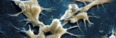 Microscopic image of prostate cancer cells in culture.